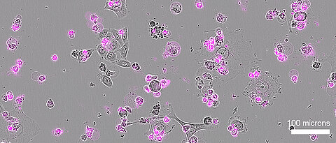Nach einer Behandlung mit Cas12a2 sterben menschliche Gebärmutterhalskrebszellen (grau dargestellt) großflächig ab, erkennbar an den Apoptose-Markern (magenta).