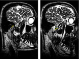 MRI in the temporomandibular joint